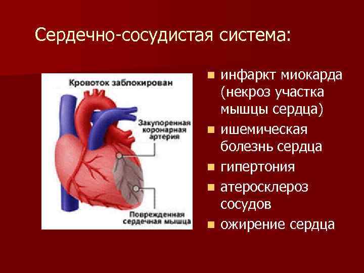 Сердечно-сосудистая система: n n n инфаркт миокарда (некроз участка мышцы сердца) ишемическая болезнь сердца