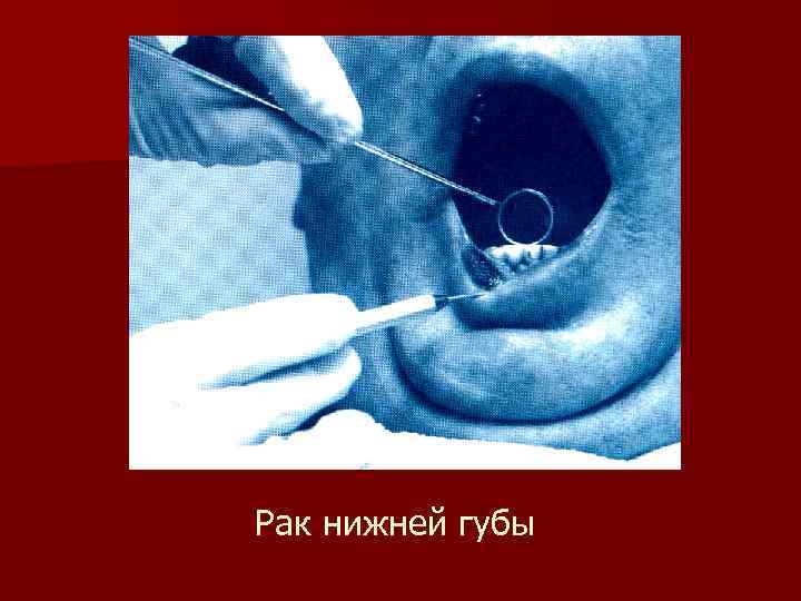 Рак нижней губы 