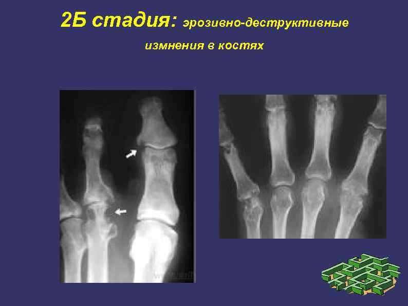 2 Б стадия: эрозивно-деструктивные измнения в костях 