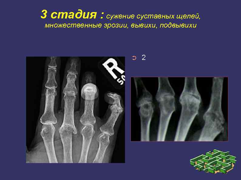 3 стадия : сужение суставных щелей, множественные эрозии, вывихи, подвывихи ➲ 2 