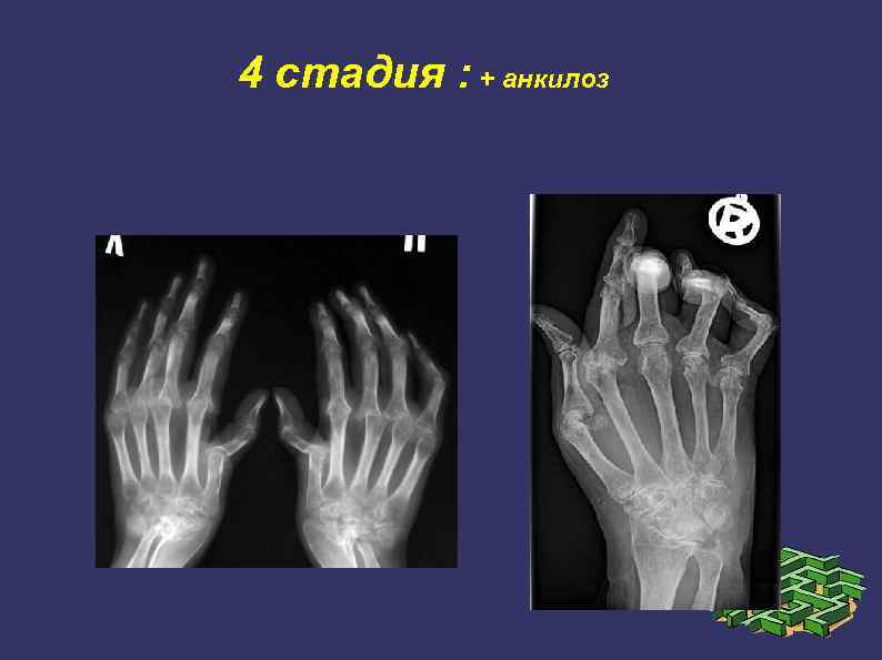 Анкилоз это. Анкилоз межфалангового сустава. Анкилоз лучезапястного сустава. Ревматоидный артрит анкилоз.