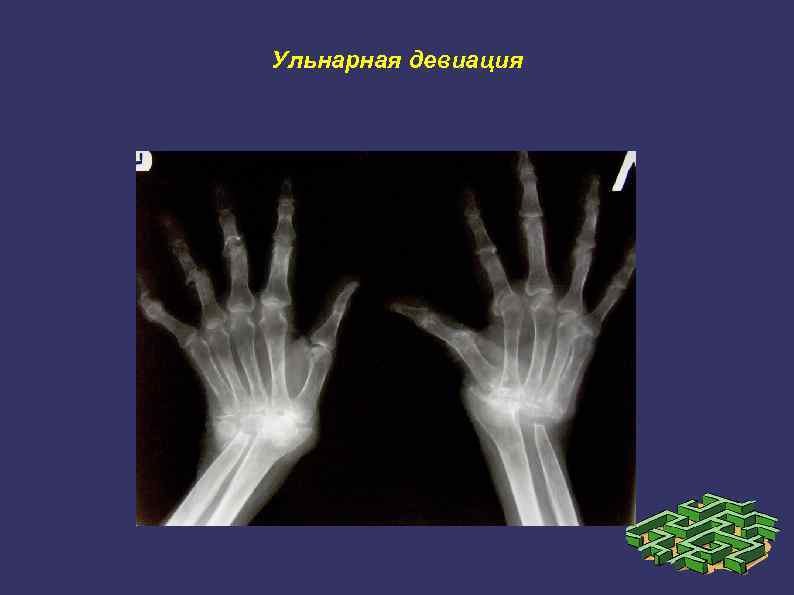 Ульнарная девиация 