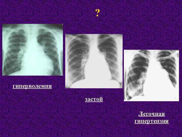 ? гиперволемия застой Легочная гипертензия 