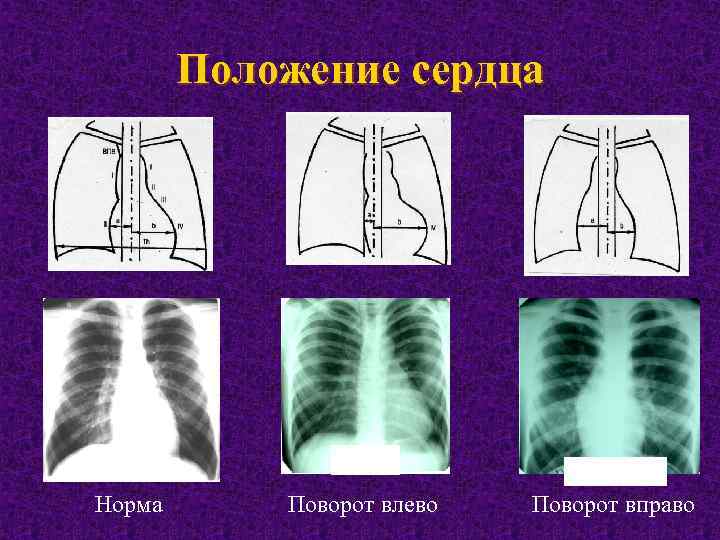 Положение сердца Норма Поворот влево Поворот вправо 
