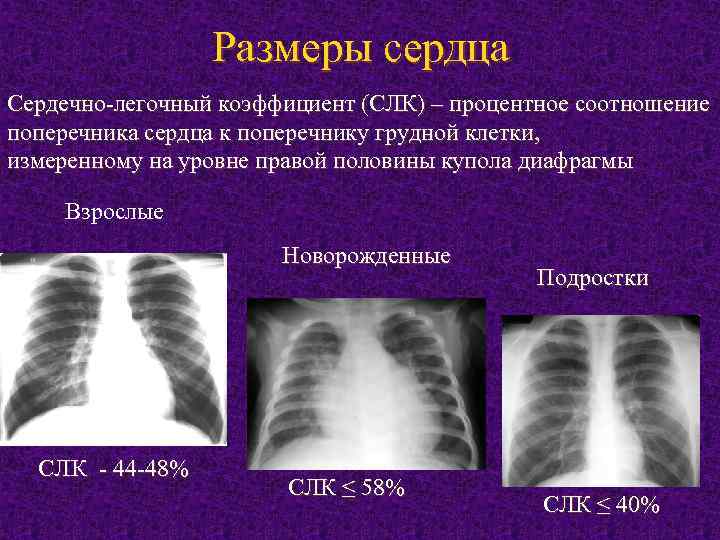 Размеры сердца. Сердечно-легочный коэффициент. Рентгенограмма сердца в норме. Поперечник сердца на рентгенограмме. Сердечно-легочный коэффициент в норме:.