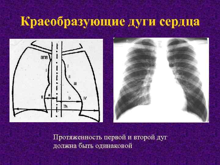 Краеобразующие дуги сердца Протяженность первой и второй дуг должна быть одинаковой 