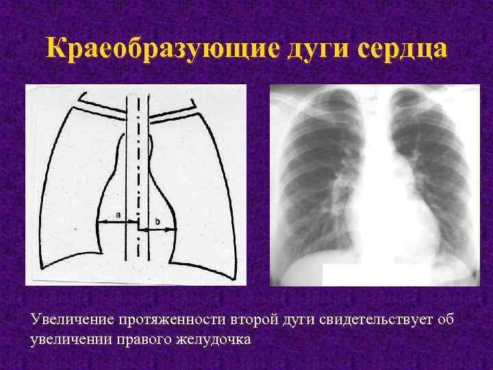 Краеобразующие дуги сердца Увеличение протяженности второй дуги свидетельствует об увеличении правого желудочка 
