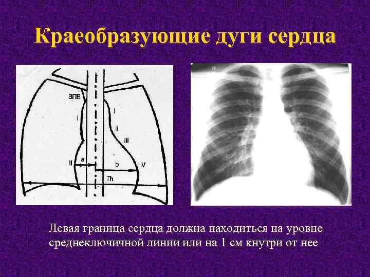 Краеобразующие дуги сердца Левая граница сердца должна находиться на уровне среднеключичной линии или на