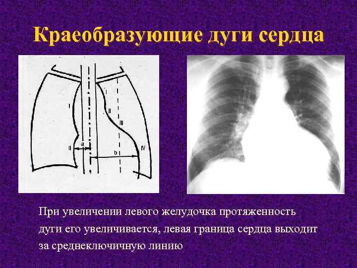 Краеобразующие дуги сердца При увеличении левого желудочка протяженность дуги его увеличивается, левая граница сердца