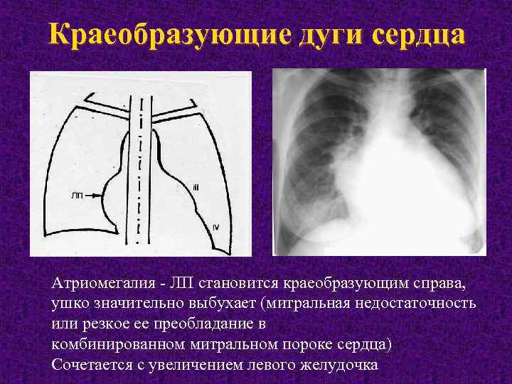 Недостаточность клапанов бпв справа