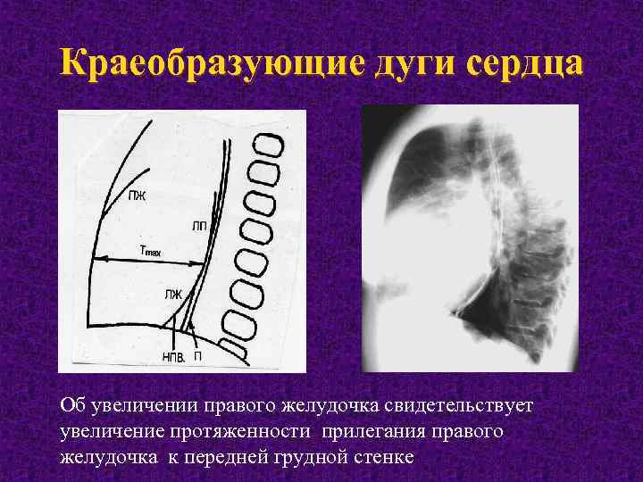 Увеличено правое. Рентгеноанатомия сердца и крупных сосудов. Дуги сердца на рентгенограмме. Рентгеноанатомия сердца и крупных сосудов в норме. Рентгеноанатомия сердца в норме.