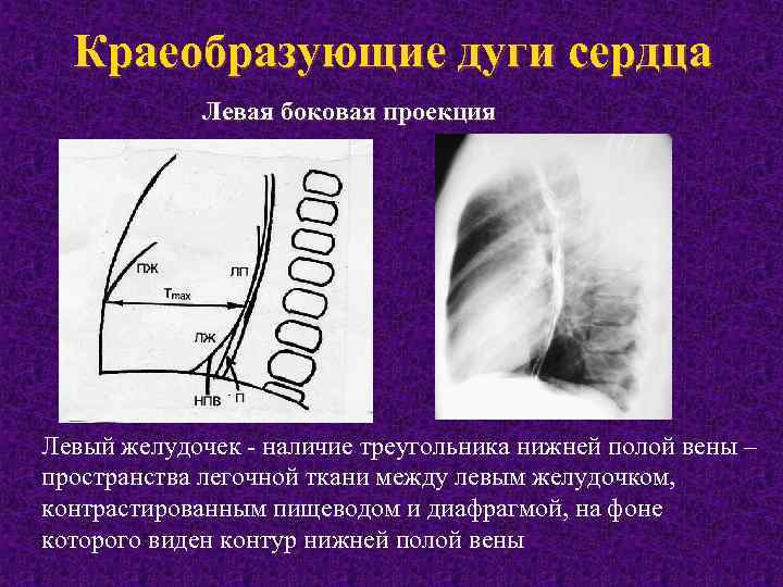 Дуги сердца на рентгенограмме схема