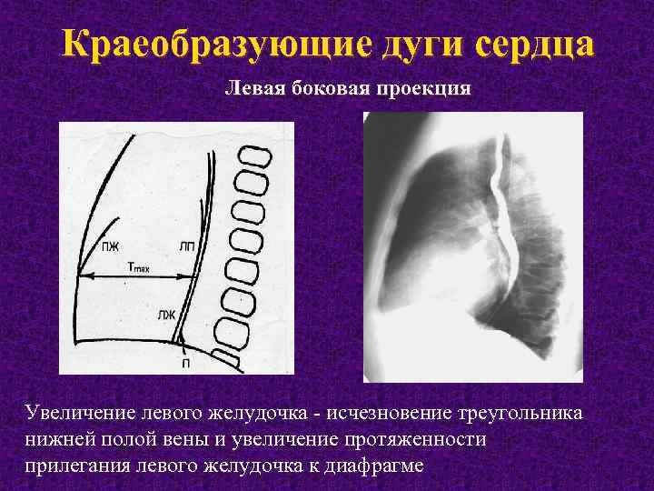 Краеобразующие дуги сердца Левая боковая проекция Увеличение левого желудочка исчезновение треугольника нижней полой вены