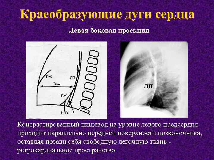 Проекция дуги. Проекции сердца на рентгенограмме. Рентгенологические проекции для сердца. Рентгенограмма сердца в боковой проекции. Левая боковая проекция сердца.