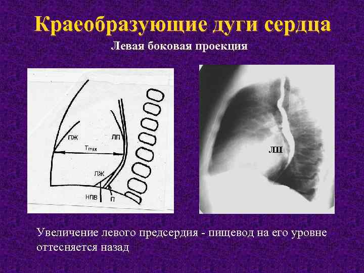 Дуги сердца на рентгенограмме схема