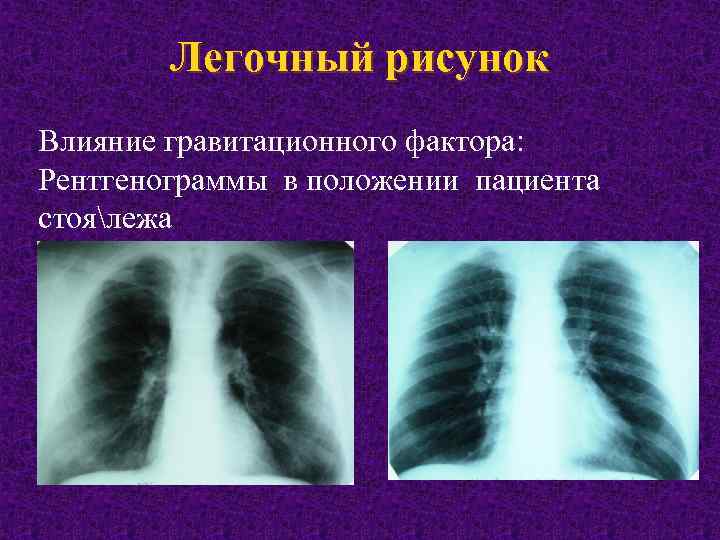 Легочный рисунок. Изменение легочного рисунка. Патология легочного рисунка. Легочной рисунок на рентгенограмме.