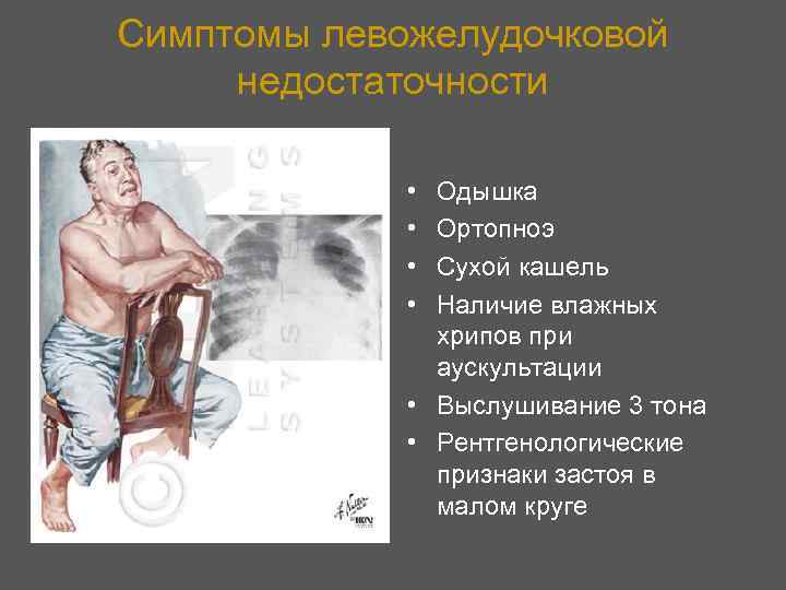 Симптомы левожелудочковой недостаточности • • Одышка Ортопноэ Сухой кашель Наличие влажных хрипов при аускультации