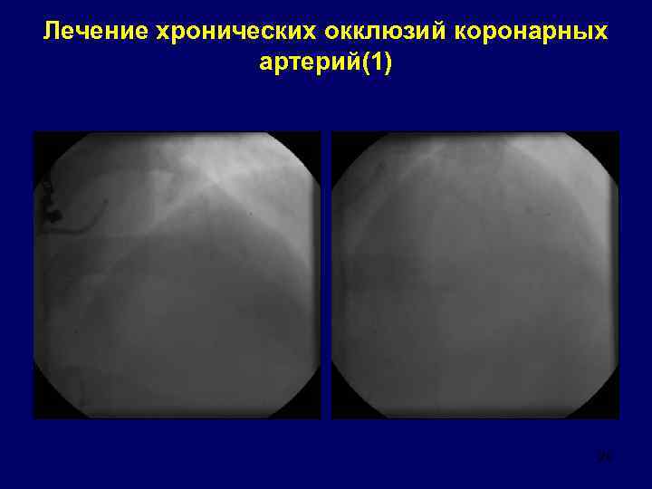 Лечение хронических окклюзий коронарных артерий(1) 29 