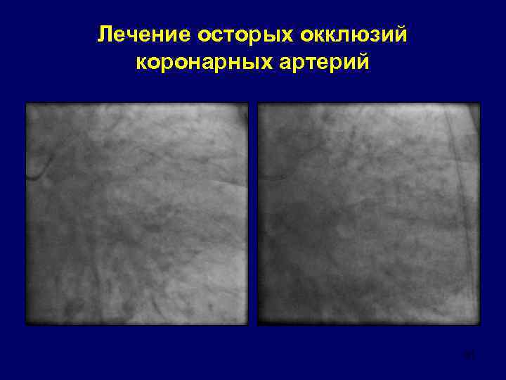 Лечение осторых окклюзий коронарных артерий 31 