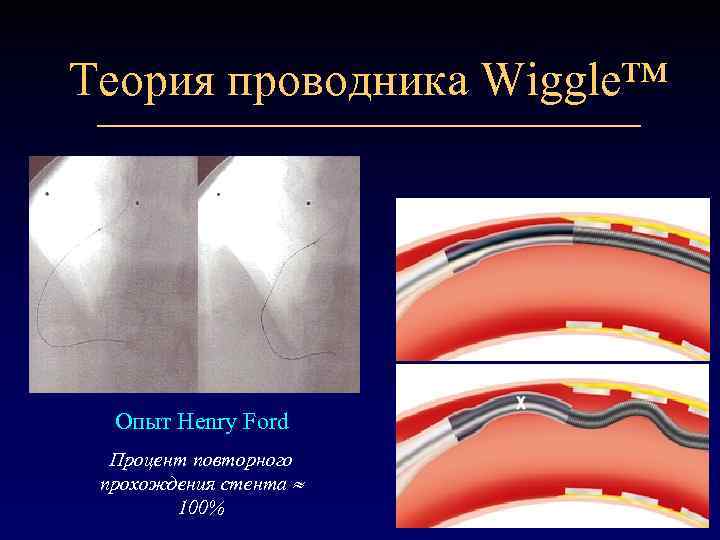 Теория проводника Wiggle™ Опыт Henry Ford Процент повторного прохождения стента 100% 