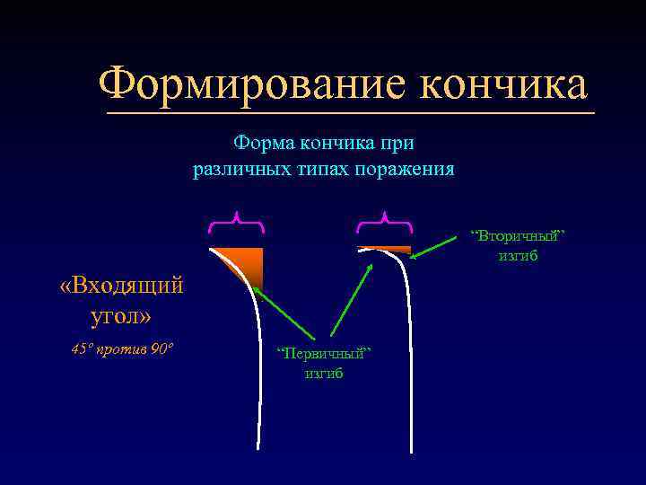 Формирование кончика Форма кончика при различных типах поражения “Вторичный” изгиб «Входящий угол» 45º против