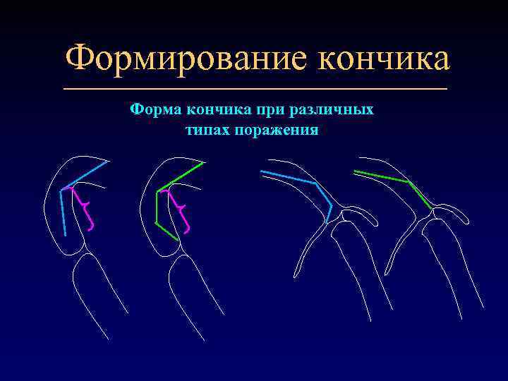 Формирование кончика Форма кончика при различных типах поражения 