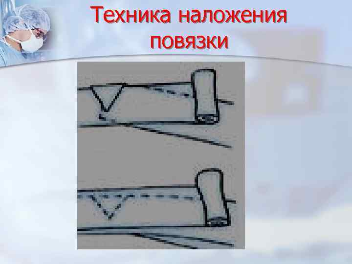 Техника наложения повязки 
