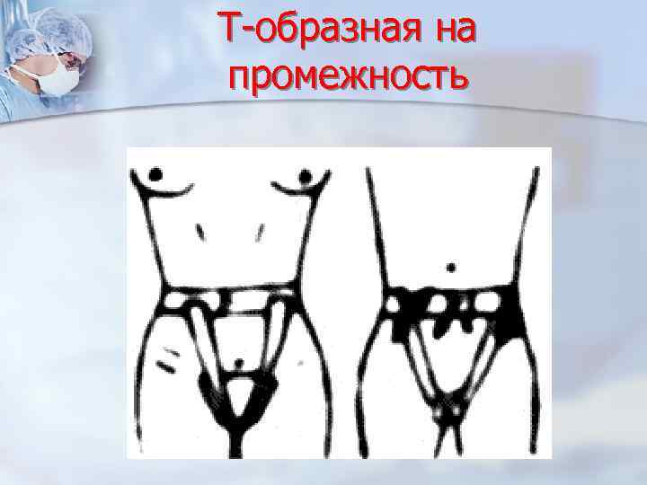 Т-образная на промежность 