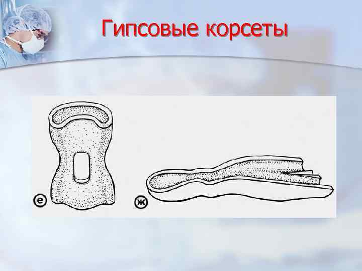 Гипсовые корсеты 