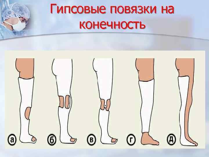 Гипсовые повязки на конечность 
