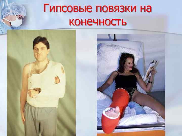 Гипсовые повязки на конечность 