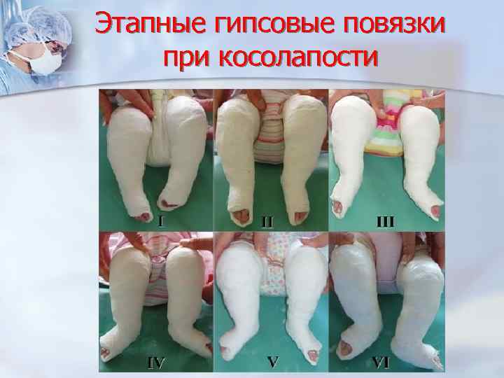 Этапные гипсовые повязки при косолапости 