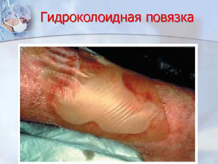 Гидроколоидная повязка 