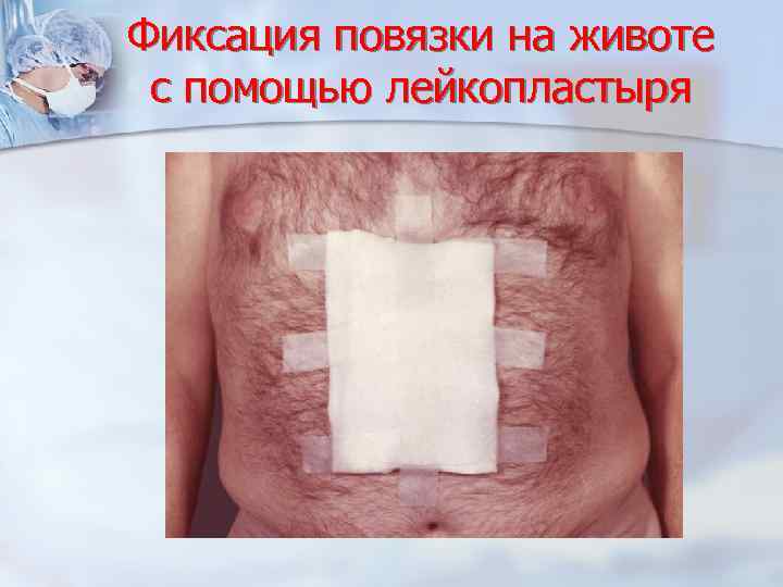 Фиксация повязки на животе с помощью лейкопластыря 