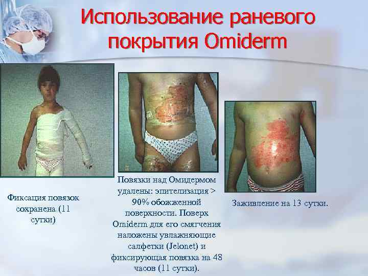 Использование раневого покрытия Omiderm Фиксация повязок сохранена (11 сутки) Повязки над Омидермом удалены: эпителизация