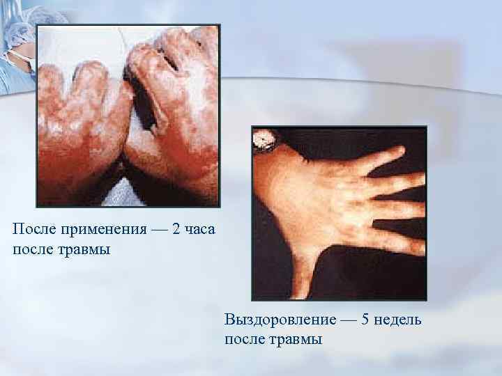 После применения — 2 часа после травмы Выздоровление — 5 недель после травмы 