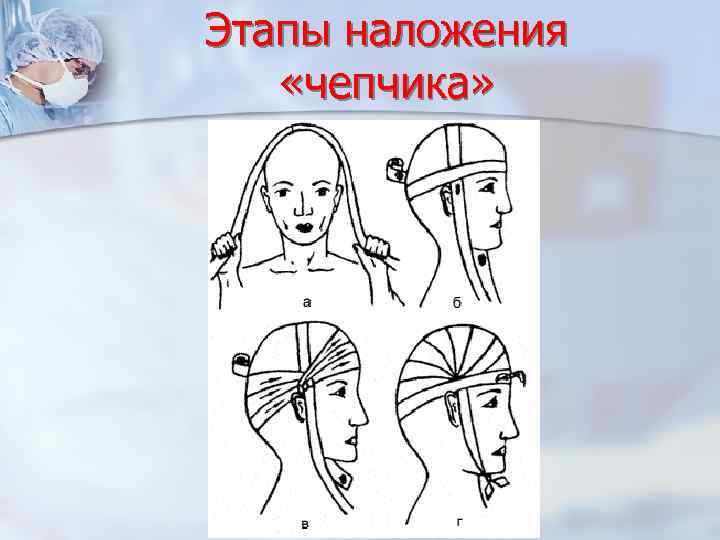 Этапы наложения «чепчика» 