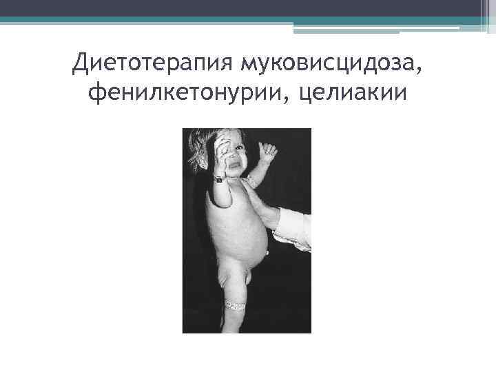 Диетотерапия муковисцидоза, фенилкетонурии, целиакии 