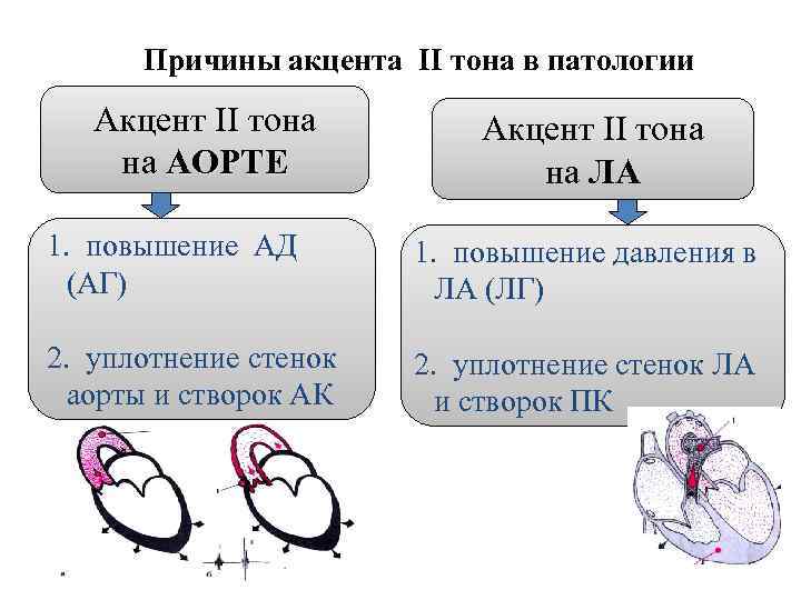 Причины акцента II тона в патологии Акцент II тона на АОРТЕ Акцент II тона