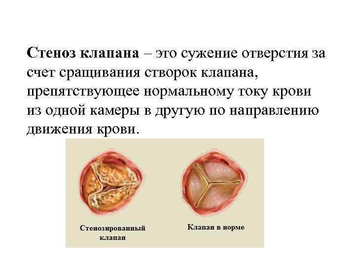 Стеноз клапана – это сужение отверстия за счет сращивания створок клапана, препятствующее нормальному току