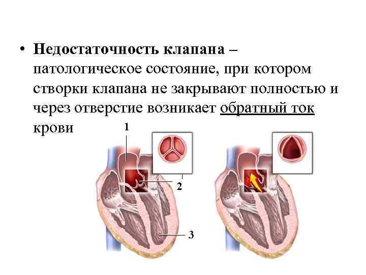 • Недостаточность клапана – патологическое состояние, при котором створки клапана не закрывают полностью