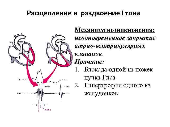 Расщепление и раздвоение I тона Механизм возникновения: неодновременное закрытие атрио-вентрикулярных клапанов. Причины: 1. Блокада