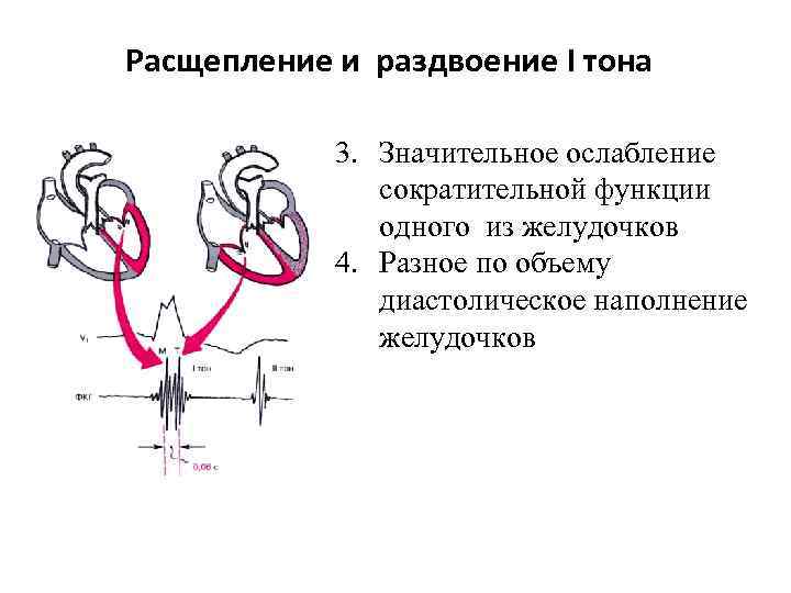Расщепление и раздвоение I тона 3. Значительное ослабление сократительной функции одного из желудочков 4.