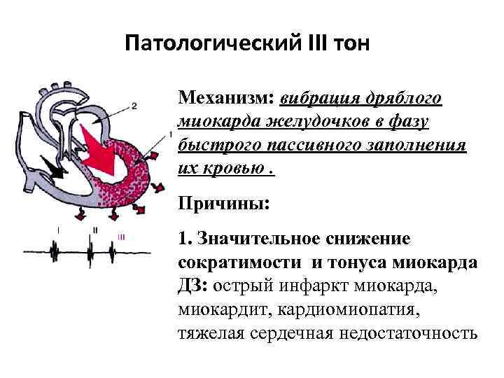 Патологический III тон Механизм: вибрация дряблого миокарда желудочков в фазу быстрого пассивного заполнения их