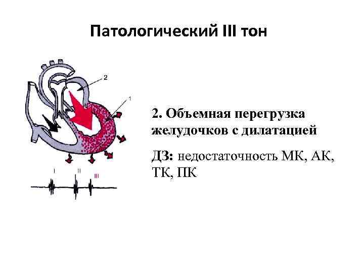 Патологический III тон 2. Объемная перегрузка желудочков с дилатацией ДЗ: недостаточность МК, АК, ТК,