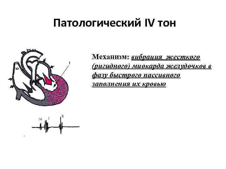 Патологический IV тон Механизм: вибрация жесткого (ригидного) миокарда желудочков в фазу быстрого пассивного заполнения