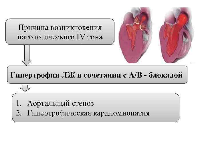 Причина возникновения патологического IV тона Гипертрофия ЛЖ в сочетании с А/В - блокадой 1.