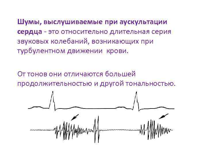 Шумы, выслушиваемые при аускультации сердца - это относительно длительная серия звуковых колебаний, возникающих при