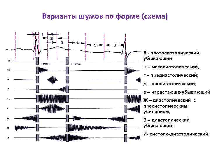 Варианты шумов по форме (схема) б - протосистолический, убывающий в – мезосистолический, г –