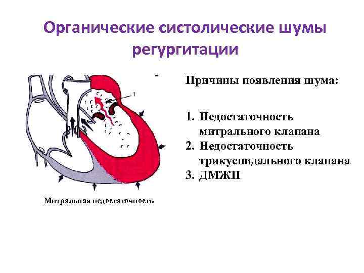 Органические систолические шумы регургитации Причины появления шума: 1. Недостаточность митрального клапана 2. Недостаточность трикуспидального